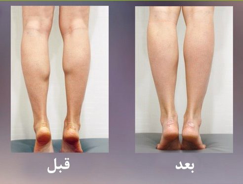 مزایای تزریق ژل در ساق پا