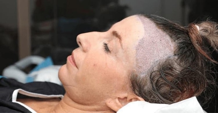 روش‌های کاشت مو در زنان