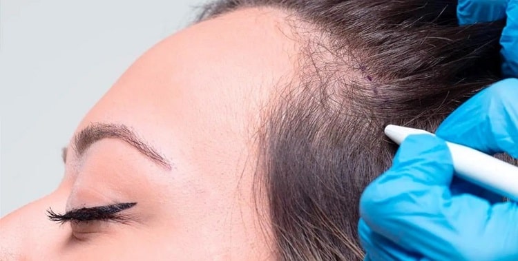 پروسه‌ی کاشت مو در زنان