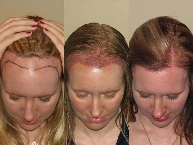 کاشت مو برای چه زنانی مناسب است؟