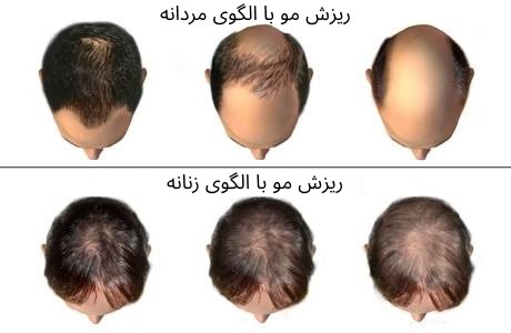 تفاوت ریزش مو در آقایان و خانم‌ها