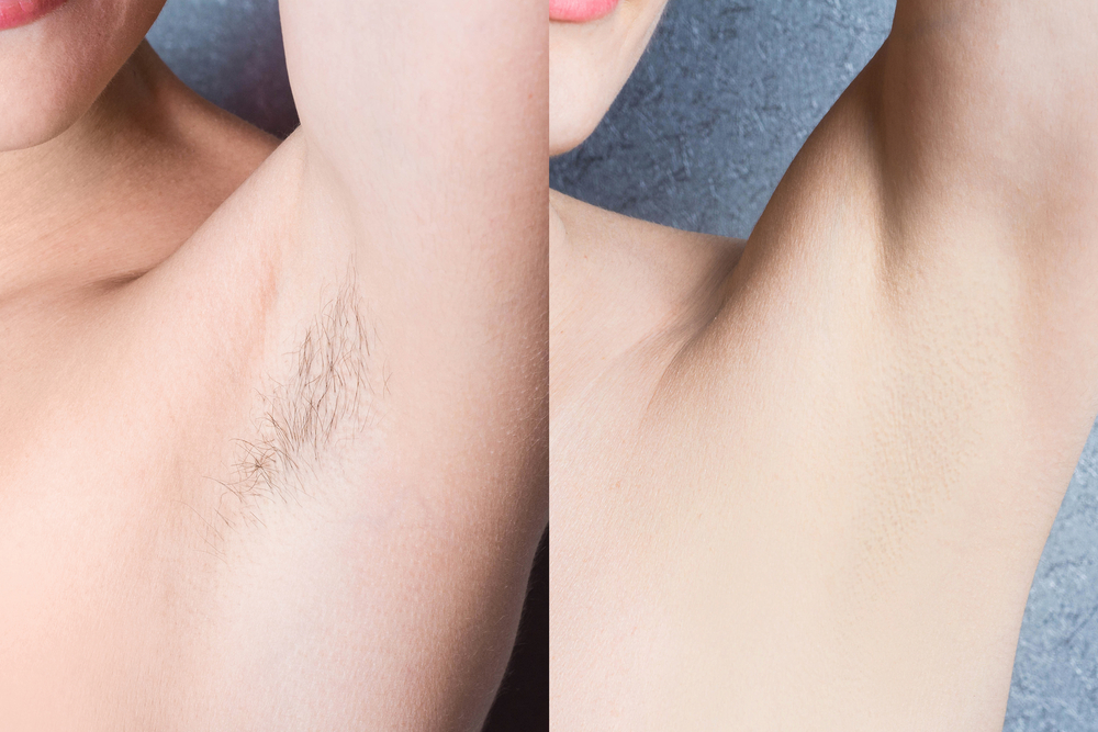 hair-removal-before-and-after