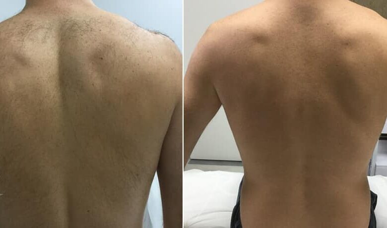 laser-hair-removal-before-and-after-treatment-new-york-1