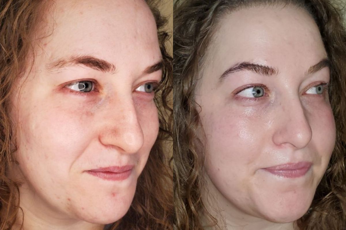 patient-4734-32-year-old-female-before-after-lactic-acid-peel-dermaplane-treatment