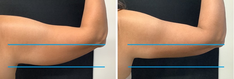 upper-arms-after-2-treatments